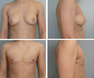 Top Surgery Portland Oregon Before and After by Dr. Tina Jenq